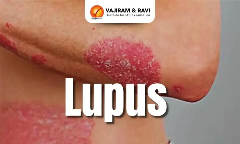 Lupus