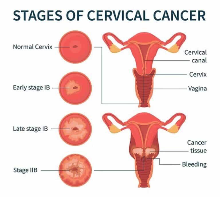 Cervical Cancer Study