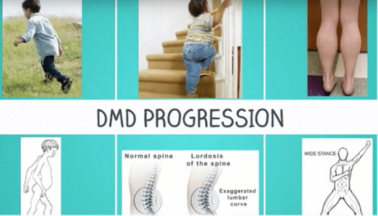 Duchenne Muscular Dystrophy