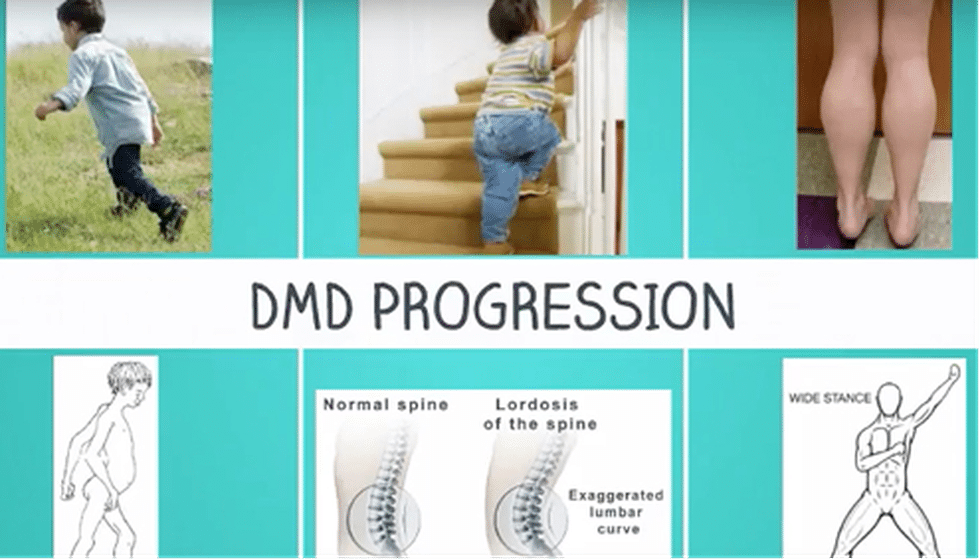 Duchenne Muscular Dystrophy