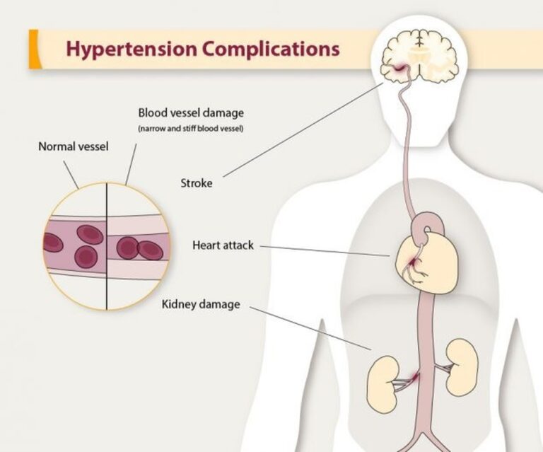 Hypertension