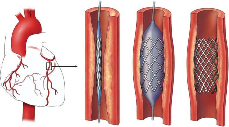 What is a Coronary Stent?