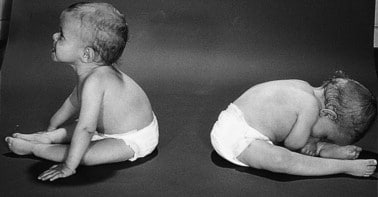 What is Spinal Muscular Atrophy Type-1?