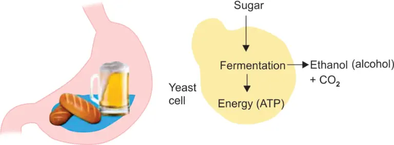 What is Auto-Brewery Syndrome?