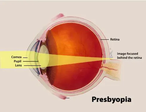 DCGI has approved new eye drop PresVu for individuals affected by Presbyopia
