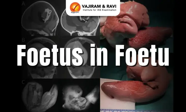 Foetus in Foetu