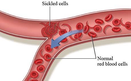 Gene Therapy for Sickle Cell Anaemia: Significance for Indian Patients