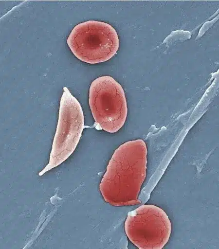 Hydroxyurea for Children: A New Approach to Treat Sickle Cell Disease