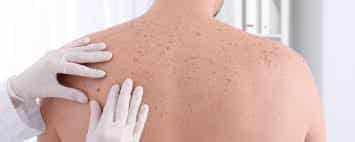 Non-melanoma skin cancer