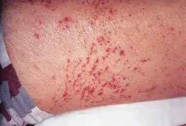 What is Thrombotic Thrombocytopenic Purpura (TTP)?