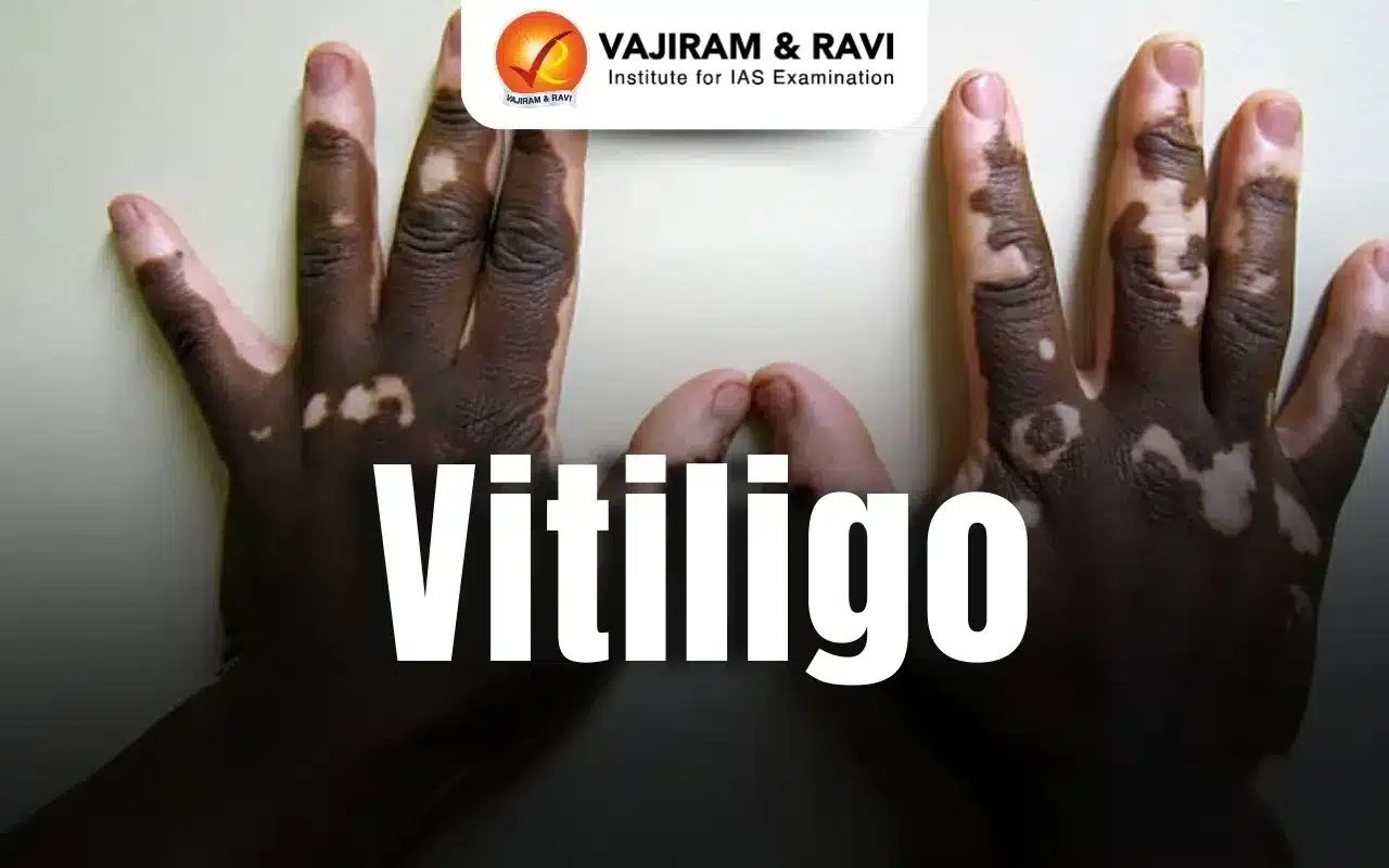 Vitiligo