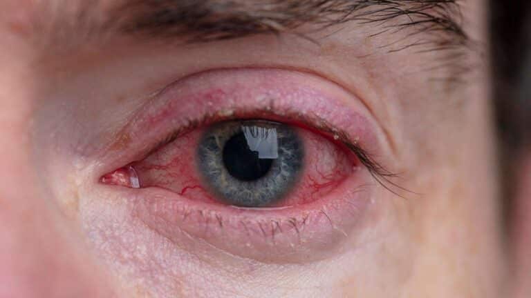 What is Conjunctivitis?