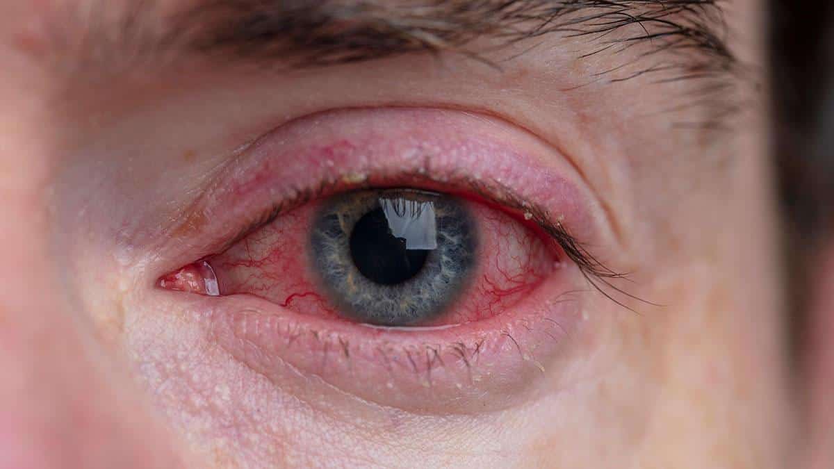 What is Conjunctivitis?