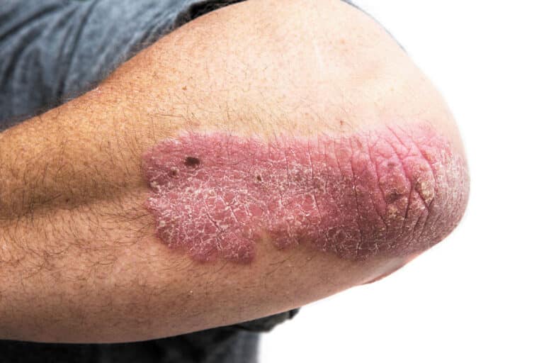 What is Psoriasis?