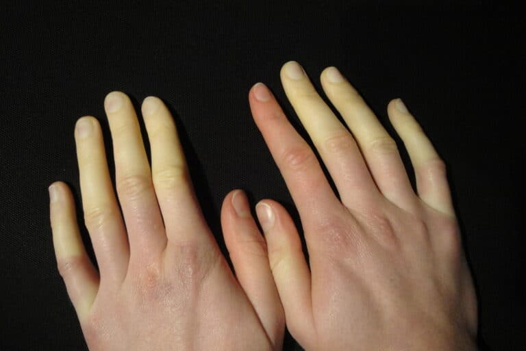 What is Raynaud’s Phenomenon?