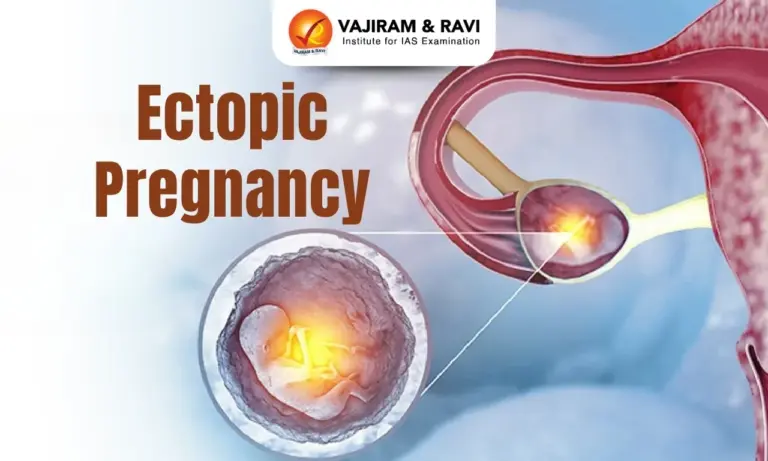 Ectopic Pregnancy