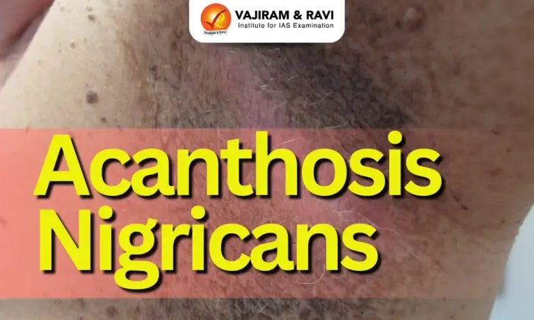 Acanthosis Nigricans