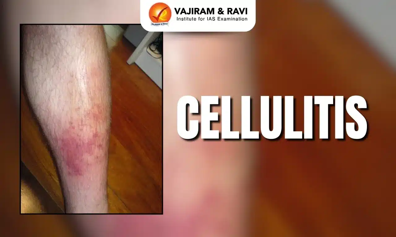 Cellulitis