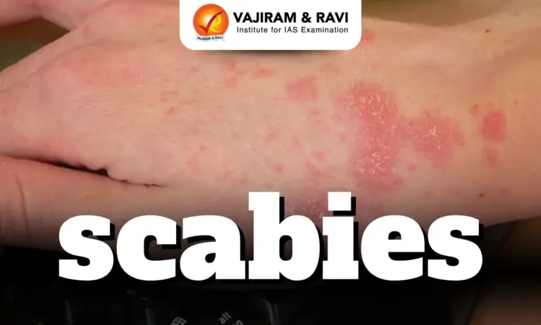 Scabies